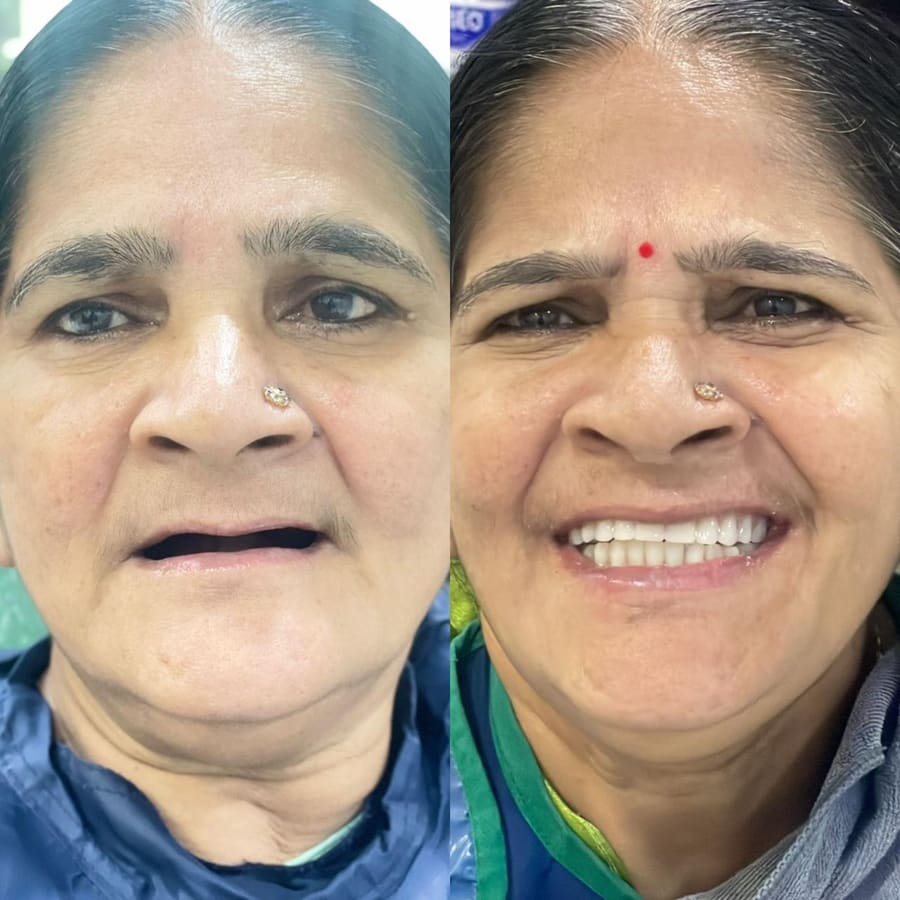 Before and after smile result 1 at Trisa Dental Solutions