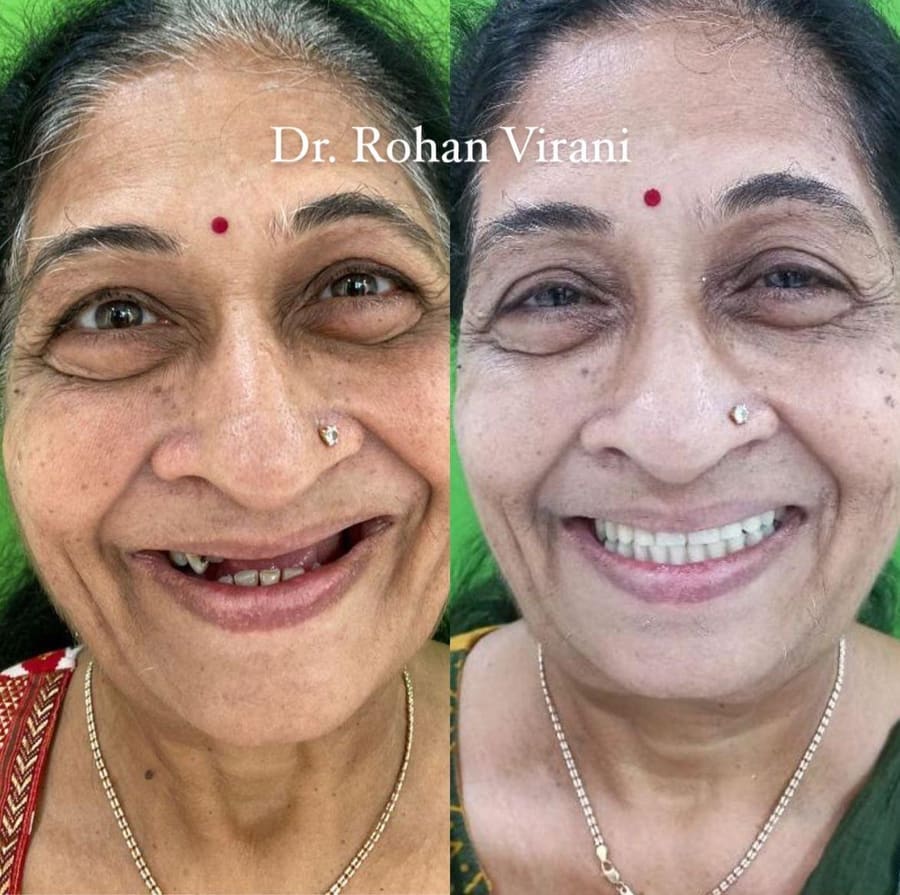 Before and after smile result 2 at Trisa Dental Solutions