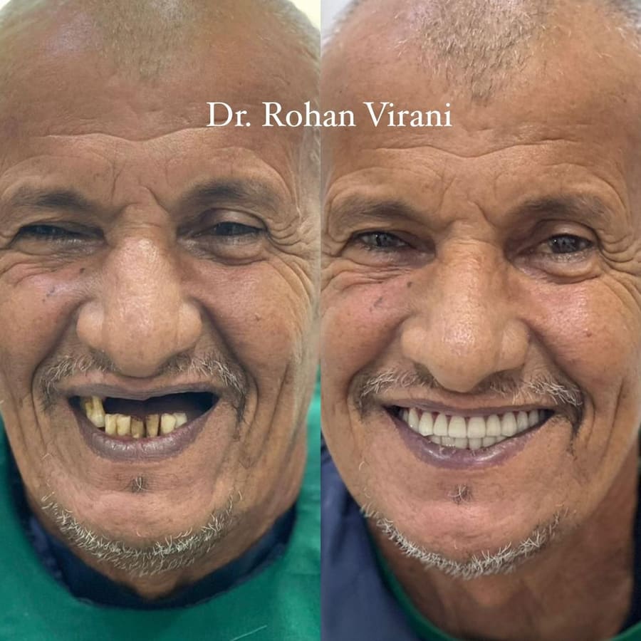 Before and after smile result 3 at Trisa Dental Solutions